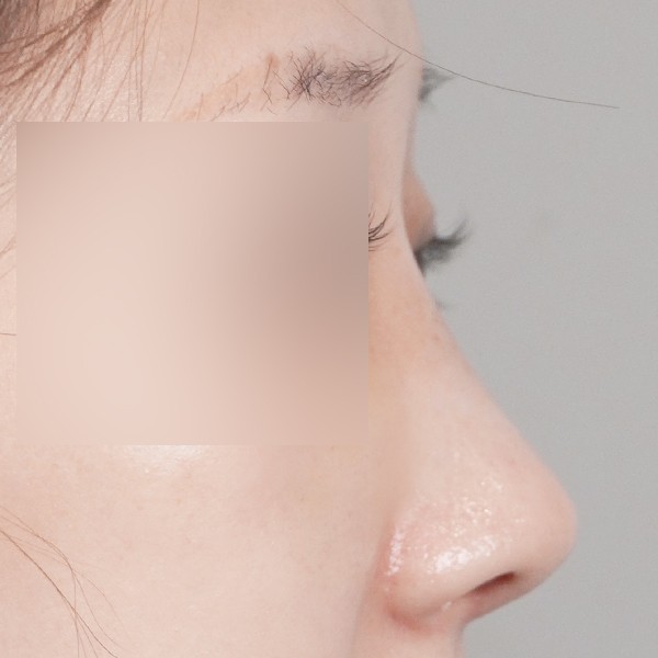 코끝,비중격,귀연골,복코,절골,매부리,짧은코