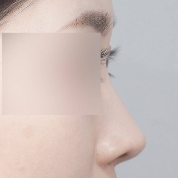 코끝,비중격,귀연골,매부리,복코,절골,짧은코