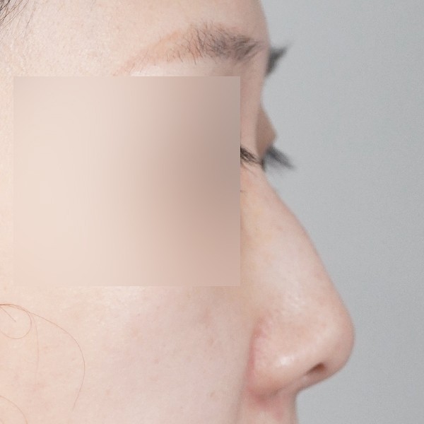 코끝,비중격,귀연골,복코,절골,매부리,짧은코